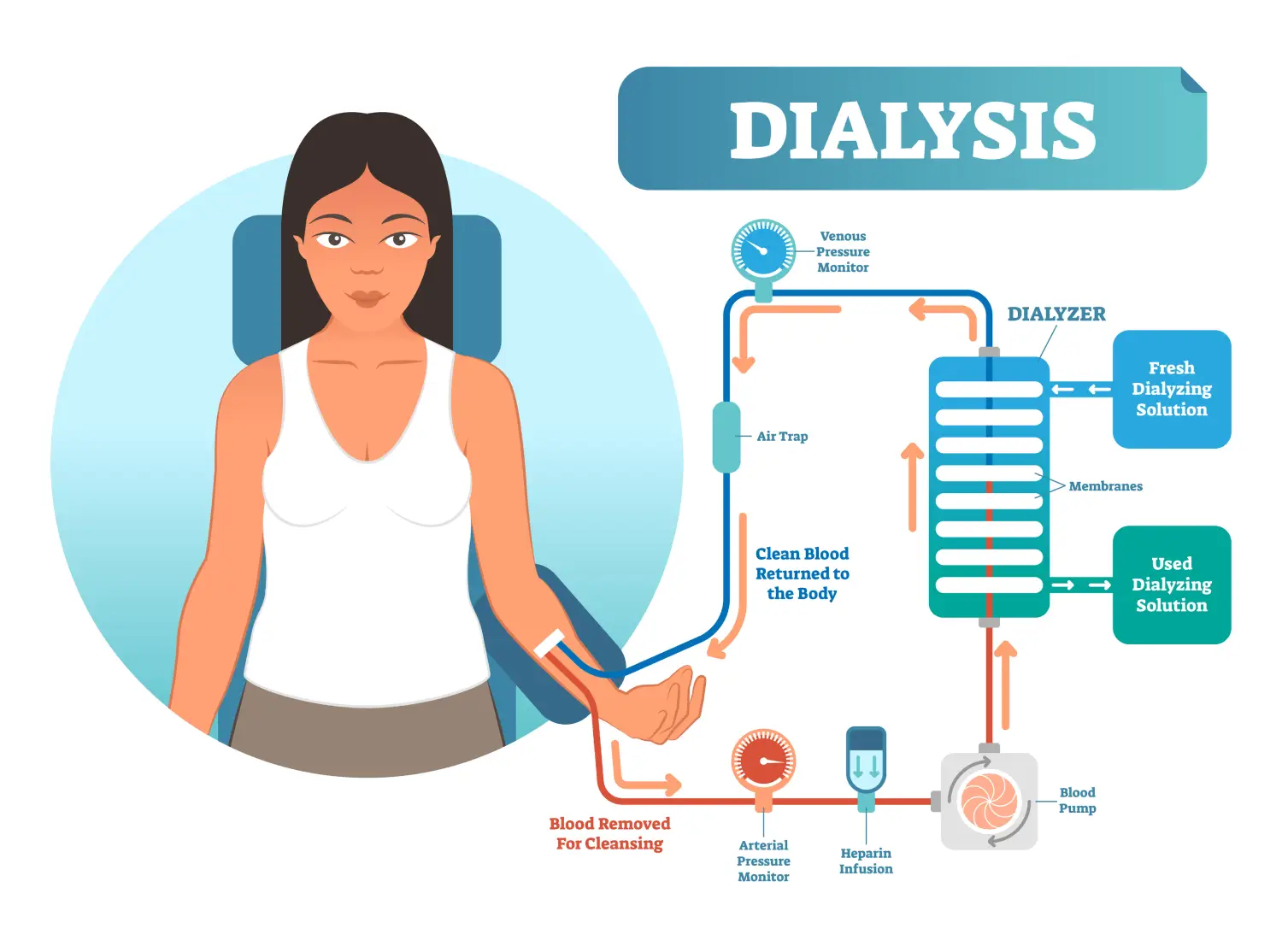 tratamiento-hemodialisis Ilustración explicativa del funcionamiento del hemodiálisis